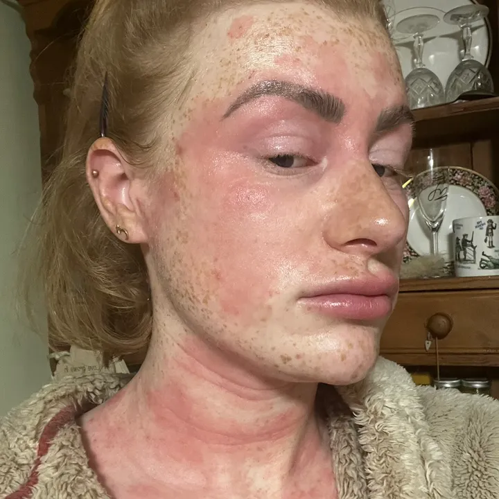 mybrokenskin
